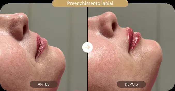 Antes e depois de preenchimento labial