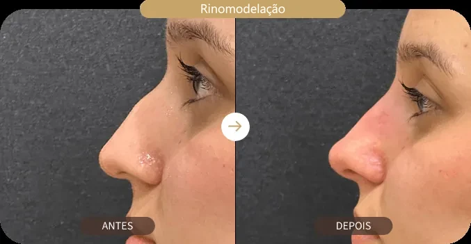 Antes e depois de rinomodelação